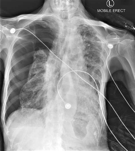 Pneumothorax | Chest X-Ray - MedSchool