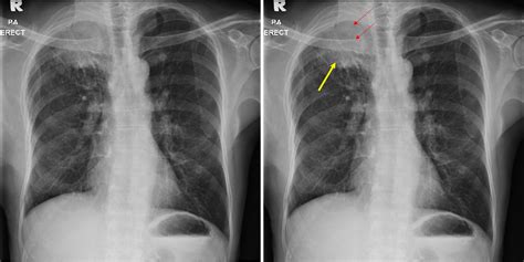 Lung cancer: Adenocarcinoma – Radiology Cases