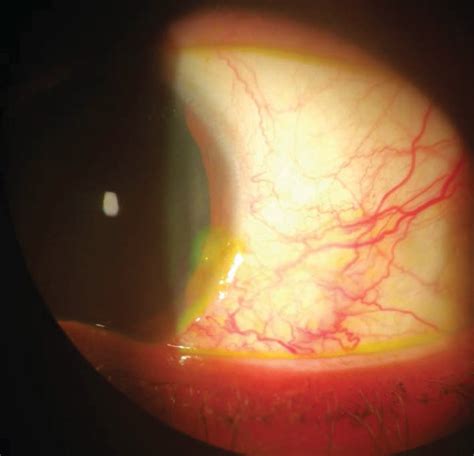 Aspect of nodular scleritis with dilatation of scleral vessels with ...