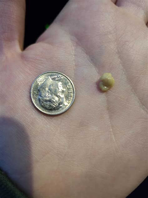 my largest tonsil stone yet courtesy of a sinus infection : r/tonsilstones