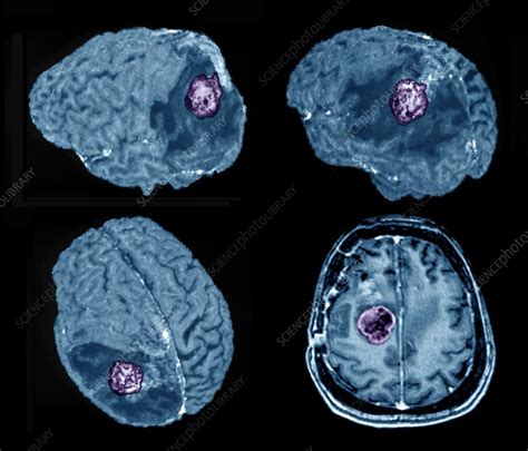 Recurrent glioma brain tumour, 3D and 2D MRI scans - Stock Image - C047/4843 - Science Photo Library