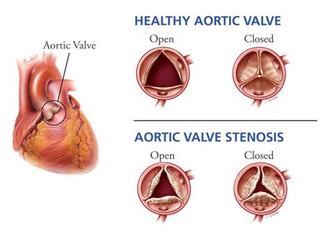 Aortic Stenosis Prognosis: Top 6 Facts to Know