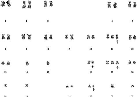 Conventional karyotyping on cultured tumor cells showing aneuploid,... | Download Scientific Diagram