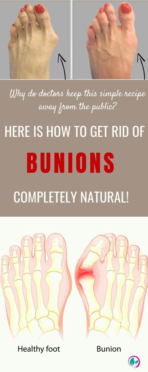 59 Best BUNION RELIEF ideas in 2021 | bunion, bunion relief, feet care