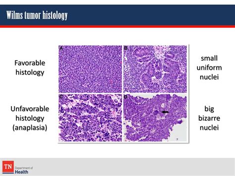 PPT - Evaluating Adequate Documentation of Wilms Tumor Histologic Presentation PowerPoint ...