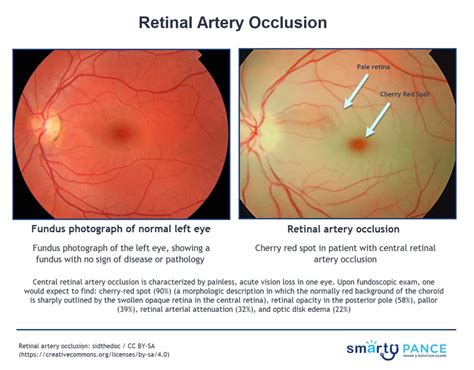 Central Retinal Artery Occlusion Anatomy