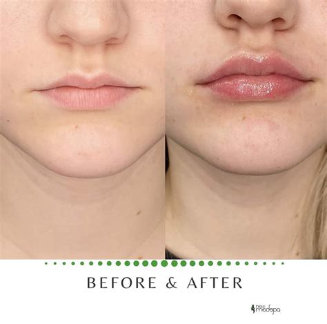 Lip Augmentation Before and After | Lip augmentation, Botox fillers ...