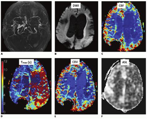 Brain MR Perfusion Imaging: Cerebral Ischemia | Radiology Key