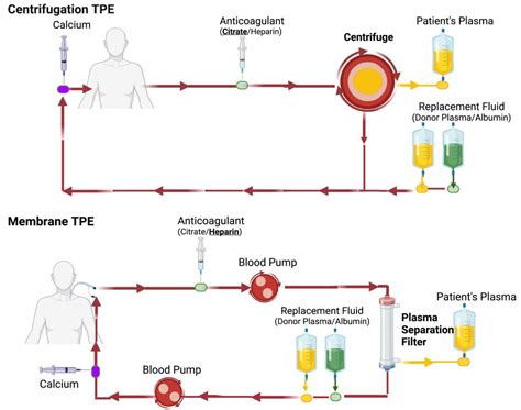 therapeutic plasma exchange – AJKD Blog