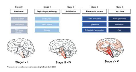 Parkinsons Disease Progression Stages - EroFound