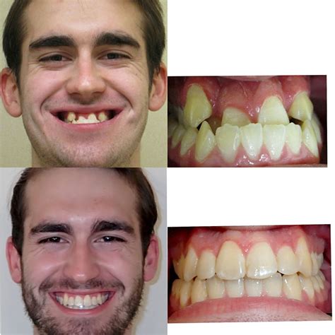 Before & After Braces | Wazio Orthodontics