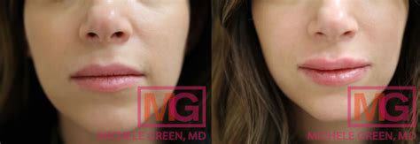 Restylane vs. Juvederm for Lips, Face, Under Eyes - Dr. Michele Green M.D.