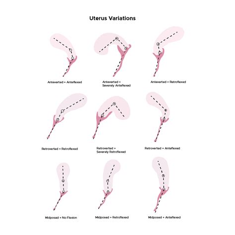 TiltedUterus — Most common: Anteverted + anteflexed (forward...