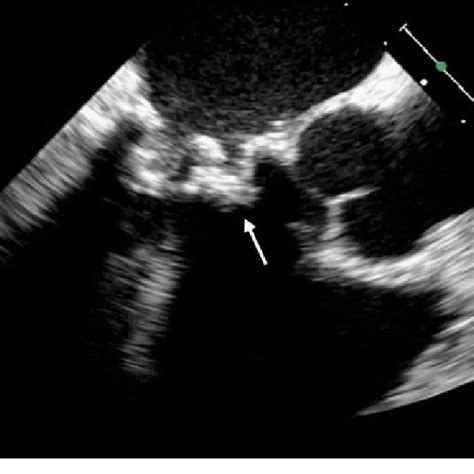 (PDF) Mitral bioprosthetic valve stenosis in a patient with antiphospholipid antibody syndrome ...