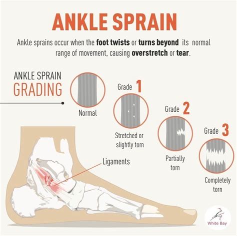 Ankle Sprain Grades