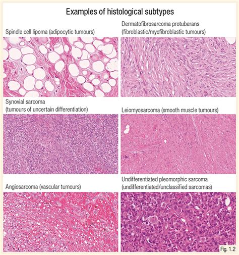 Fibrosarcoma Histology