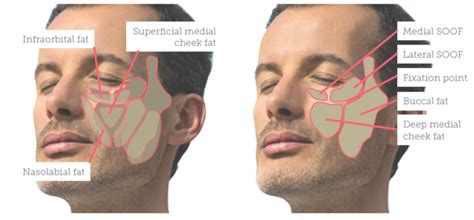 Treating the Male Mid-face - Aesthetics