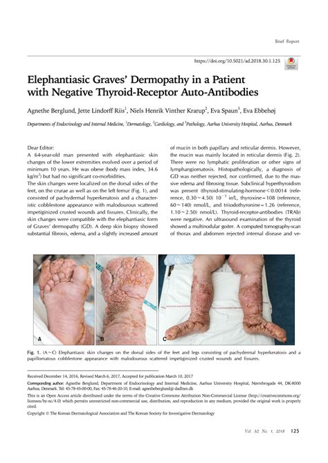 (PDF) Elephantiasic Graves' Dermopathy in a Patient with Negative Thyroid-Receptor Auto-Antibodies