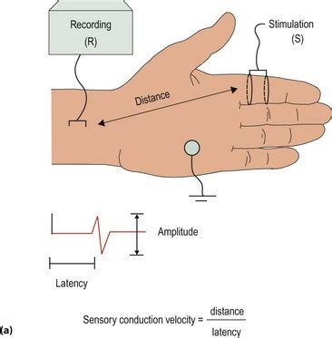 Nerve conduction studies and electromyography | Neupsy Key