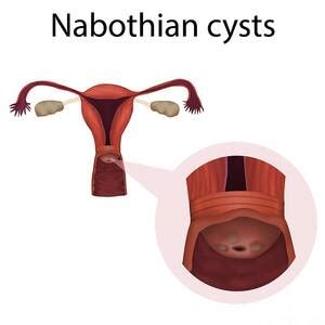 Nabothian Cysts And Healthy Cervix Photograph by Veronika Zakharova/science Photo Library