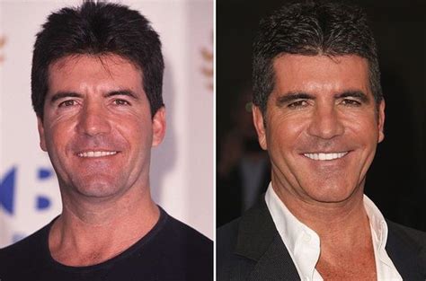 Simon Cowell before and after plastic surgery (26) | Celebrity plastic ...