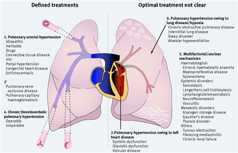 Pulmonary hypertension: diagnosis and management | The BMJ