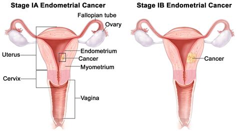 Endometrial Cancer - Causes, Early Signs, Symptoms, Treatment