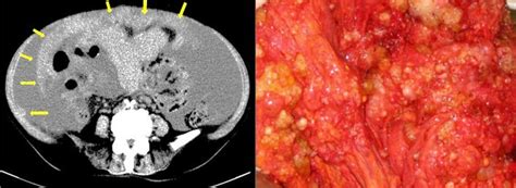 Omental Cake | Epomedicine