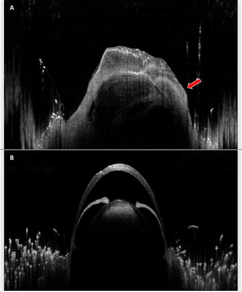 (A) OCT image of right eye treated with 5 × 10 5 UM-SCC-1 cells. OCT... | Download Scientific ...