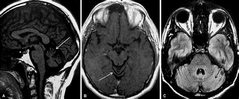 Brain MRI of a patient with alcoholic cerebellar degeneration (ACD).... | Download Scientific ...