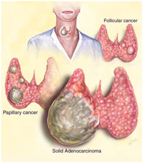 Follicular Thyroid Carcinoma - Dr.Thind