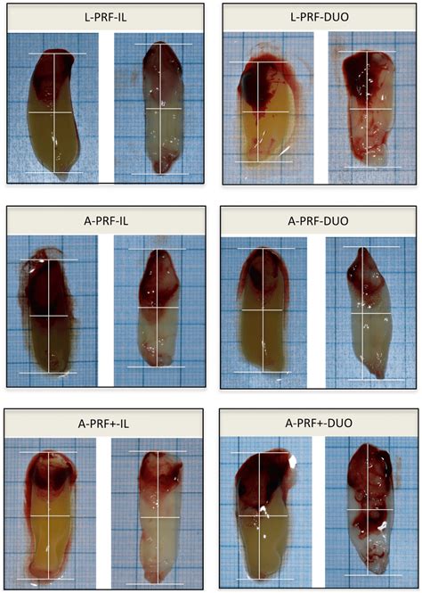 Why Big Blood Clots During Period at Tommy Jacobs blog