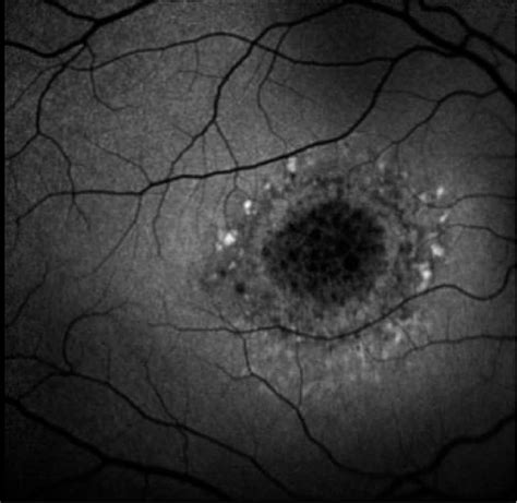 Fundus autofluorescence (FAF) accentuates the classic bull's eye... | Download Scientific Diagram