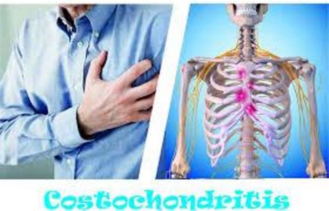 Costochondritis: an introduction to this painful condition - Nexus Newsfeed