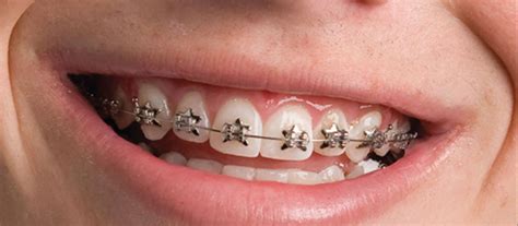 What Is Orthodontics and What Are Orthodontic Treatments? - newebmasters