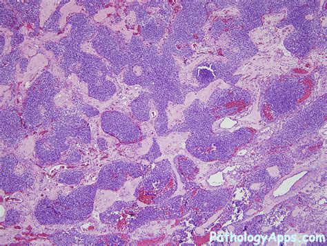 olfactory neuroblastoma pathology