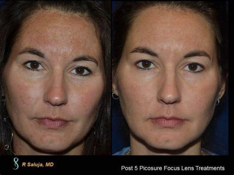 Melasma Treatment Before & After - Charlotte Huntersville, NC: Saluja Cosmetic and Laser Center