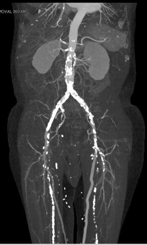 CTA Runoff with Peripheral Vascular Disease - Vascular Case Studies - CTisus CT Scanning