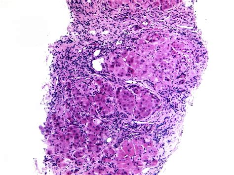 Liver Disease Histology