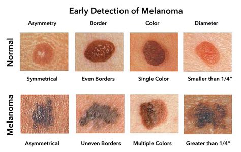 Skin Cancer Stages