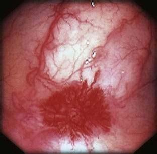 Vascular Lesions of the Gastrointestinal Tract | Clinical Gate