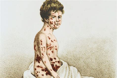 Smallpox vaccine anniversary: why we should celebrate the end of a scourge - Vox