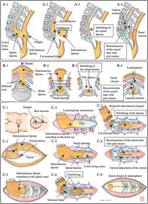 Tethered cord surgery controversy | Astral Projection