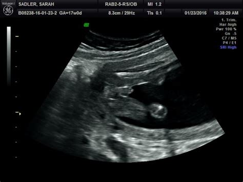 Tech said boy. Is this for sure a boy? 17 weeks ultrasound - BabyCenter