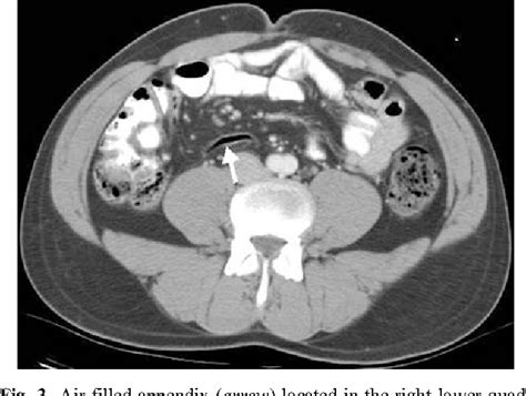 CT appearance of the normal appendix in adults | Semantic Scholar