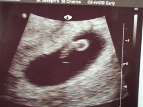 Baby fetus at 7 weeks ultrasound Idea | hostalelportalico