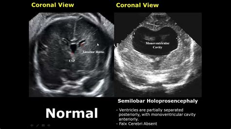 Fetal Brain Ultrasound Normal Vs Abnormal Image Appearances Comparison ...