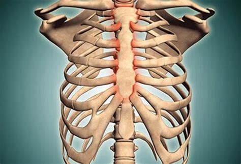 Costochondritis: Symptoms, Causes, and Treatment