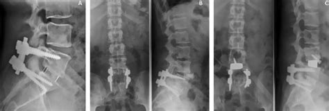 EXTREME LATERAL INTERBODY FUSION (XLIF) - LBS