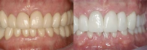 Amazing Facts About Zirconia Crowns Vs. Porcelain Fused To Metal Crowns ...